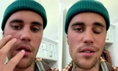 Justin Bieber Reveals Half Of His Face Is Paralyzed
