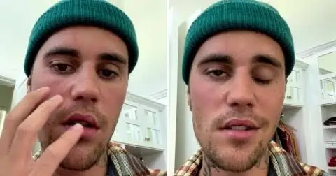 Justin Bieber Reveals Half Of His Face Is Paralyzed